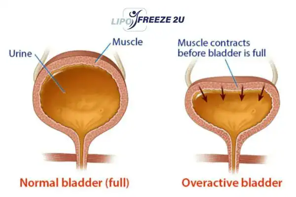 diagram of overactive bladder treatment Lowestoft