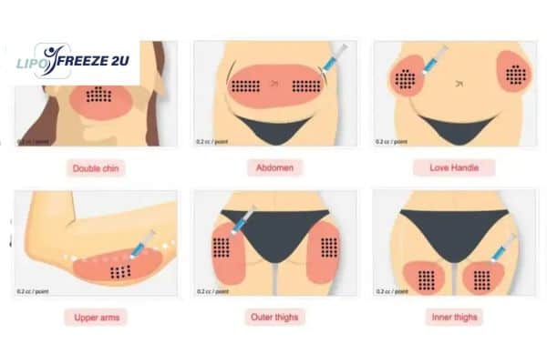 Benefits of Choosing Aqualyx for Fat Reduction Lowestoft