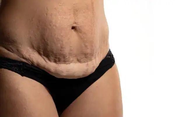 loose skin after weight loss injections Lowestoft