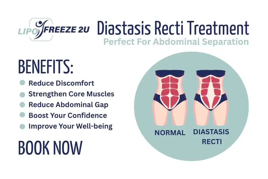 How Long Will It Take to See Improvements in Diastasis Recti Lowestoft