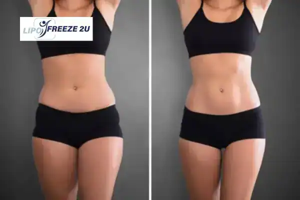 How Can LIPO FREEZE 2U Support Your Post-Pregnancy Body Recovery Lowestoft?
