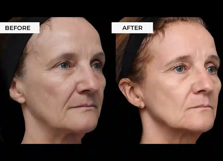 How Many RF Microneedling Sessions Will You Need to See a Difference Lowestoft?
