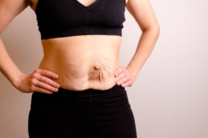 Is Surgery Really the Only Way to Repair Diastasis Recti Lowestoft?