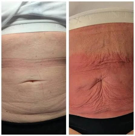 How Does RF Microneedling Improve Crepey, Thin and Uneven Skin Texture Lowestoft?