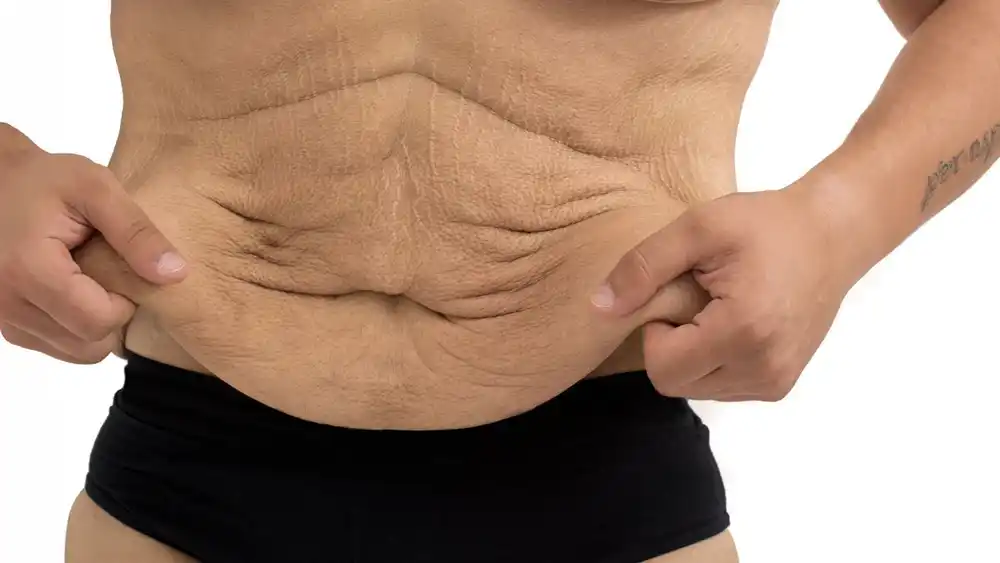 RF Microneedling for Loose Skin: How Can It Help Tighten and Reshape the Skin Lowestoft?